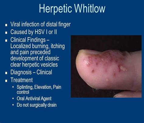 early stage whitlow pictures fingers treatment